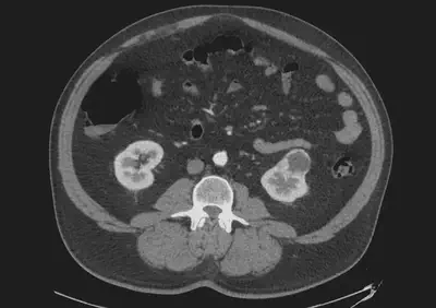 Example of a small renal mass